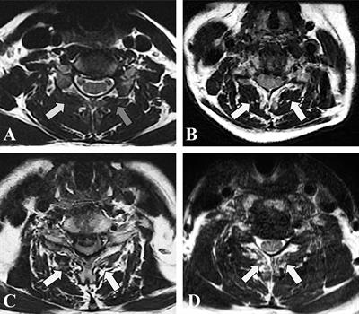 Comparison of the effectiveness of zero-profile device and plate cage construct in the treatment of one-level cervical disc degenerative disease combined with moderate to severe paraspinal muscle degeneration